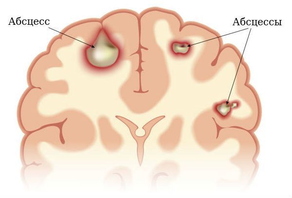 Скопление гноя в веществе головного мозга