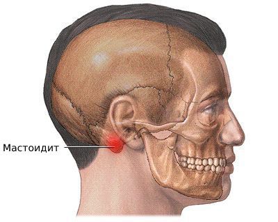 Мастоидит