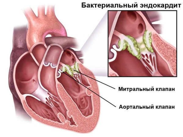 Бактериальный эндокардит