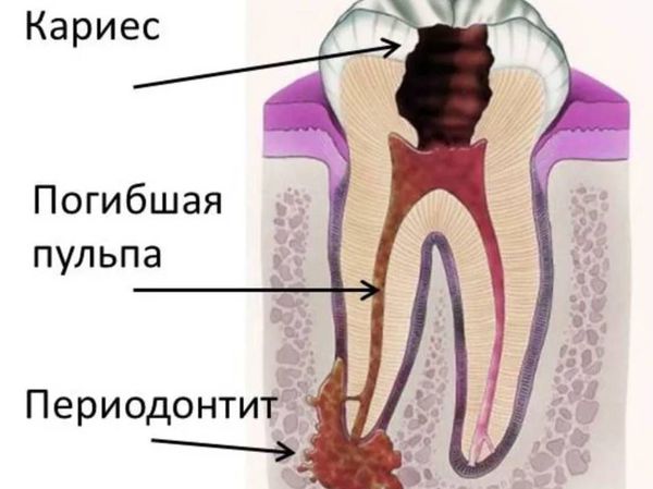 Периодонтит