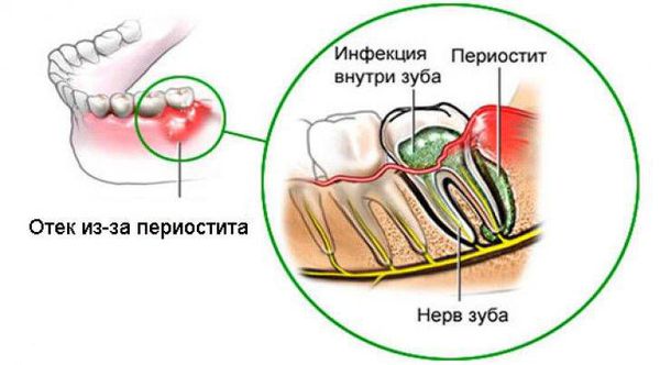 Периостит