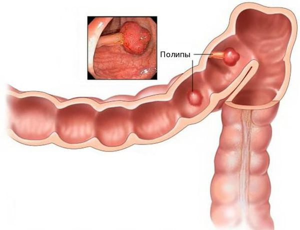 Полипы толстой кишки