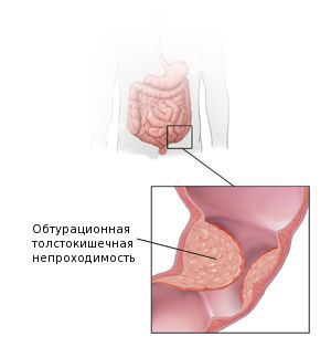 Обтурационная толстокишечная непроходимость