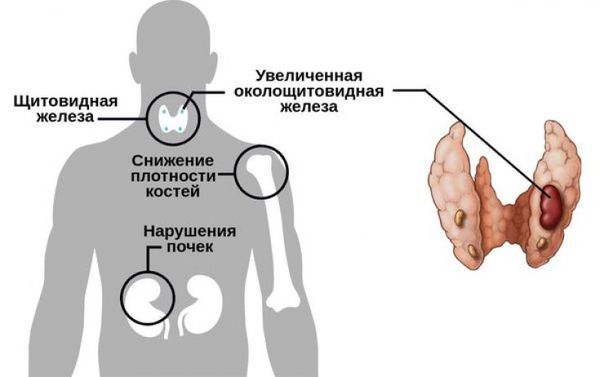 Симптомы паращитовидной железы