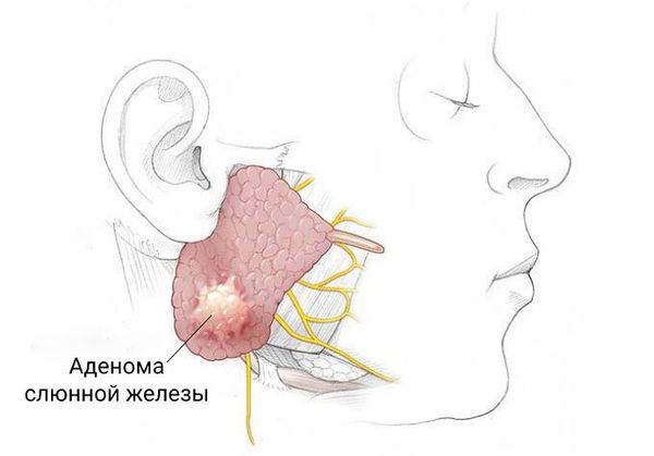 Аденома слюнной железы