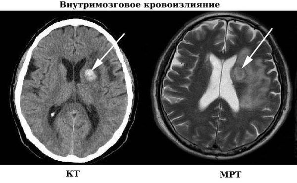 Внутримозговое кровоизлияние на КТ и МРТ 