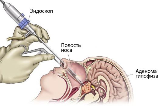 Удаление опухоли гипофиза