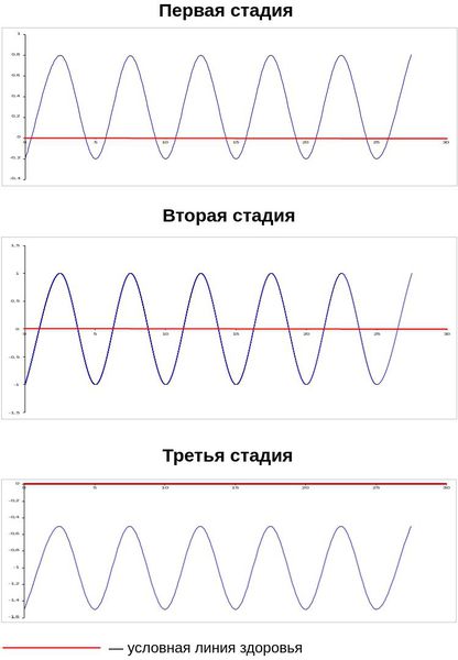 Биологический ритм на разных стадиях алкоголизма