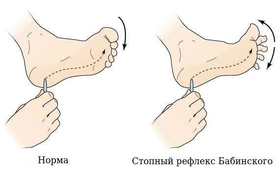 Стопный рефлекс Бабинского