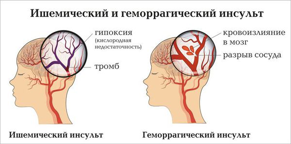 Ишемический и геморрагический инсульты