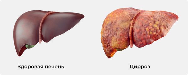 Алкогольный цирроз печени