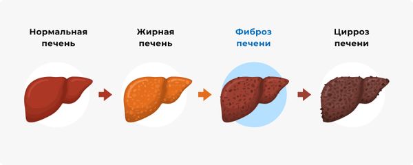 Стадии поражения печени