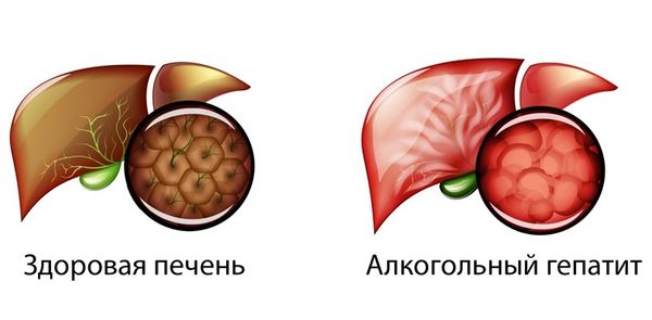 Печень при алкогольном гепатите