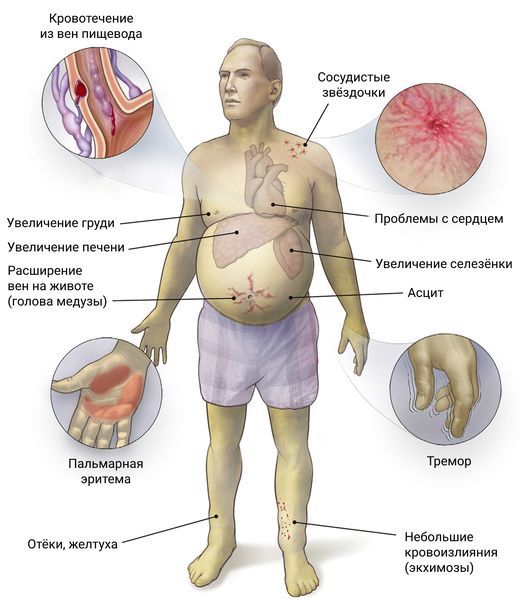 Как выглядит человек при алкогольном циррозе печени