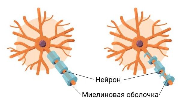 Разрушение миелинизированной оболочки