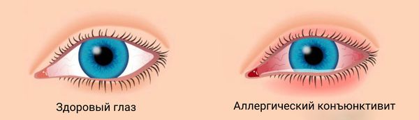 Аллергическое воспаление конъюнктивы