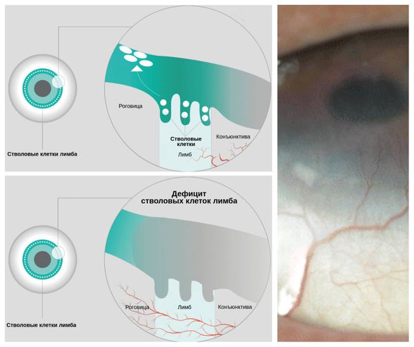 Дефицит лимбальных стволовых клеток