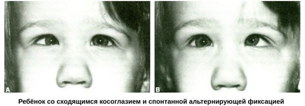 Ребёнок со сходящимся косоглазием и спонтанной альтернирующей фиксацией