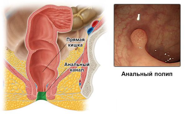 Полип анального канала