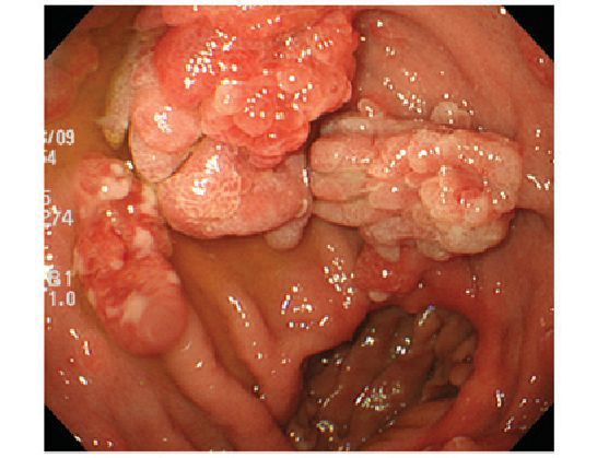 Перерождение полипа в злокачественную опухоль