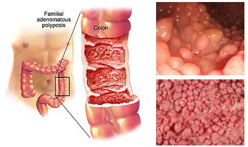 Семейный полипоз