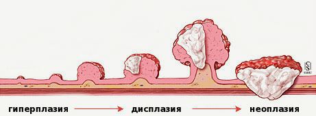 Стадии развития опухоли