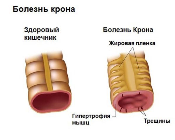 Болезнь Крона