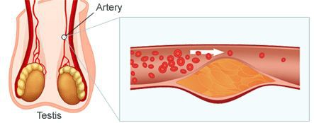 Атеросклероз сосудов тестикул
