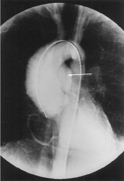 Аортография: аневризма грудной аорты