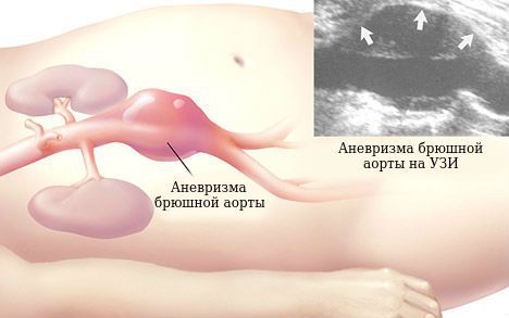 Аневризма брюшной аорты на УЗИ