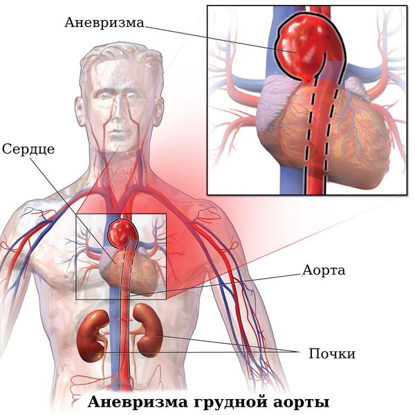 Аневризма грудной аорты