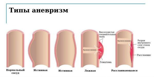 Типы аневризм по строению