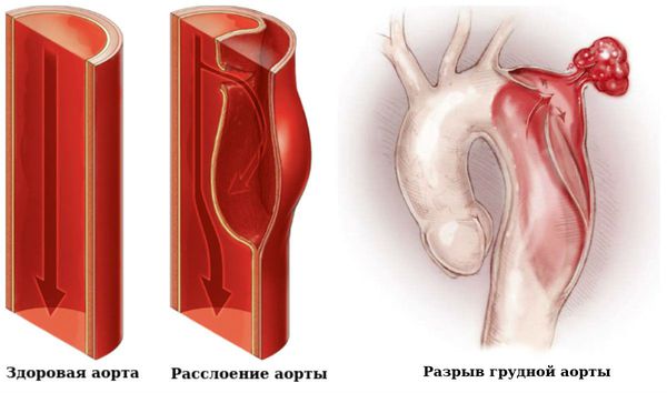 Расслоение и разрыв аорты