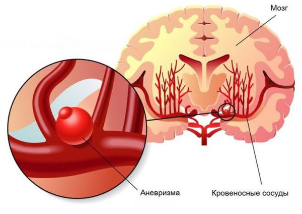 Церебральная аневризма