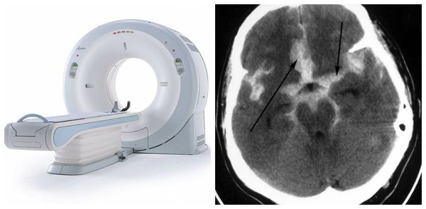 Субарахноидальное кровоизлияние на КТ