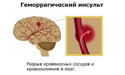 Геморрагический инсульт