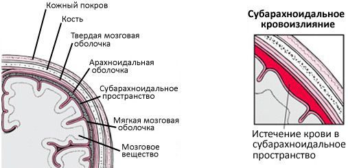 Субарахноидальное кровоизлияние