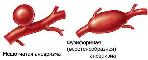 Аневризмы по форме выпячивания стенки сосуда