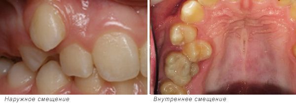 Наружное (вестибулярное) и внутреннее (оральное) смещение