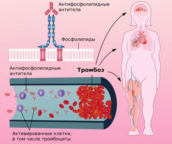 Антифосфолипидный синдром