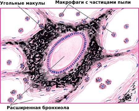 Угольные макулы