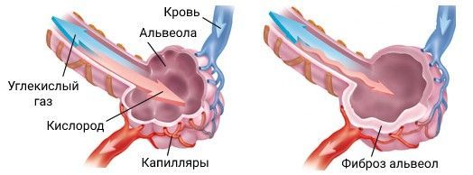 Газообмен в норме и при фиброзе