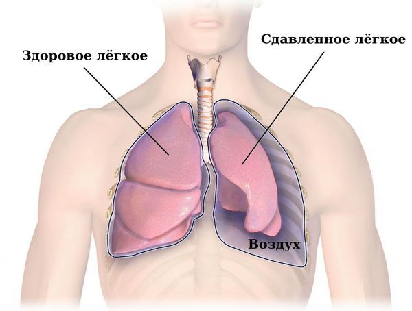 Пневмоторакс