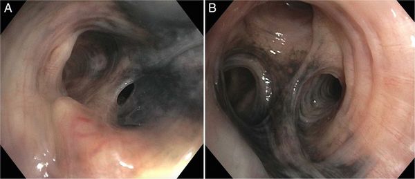 Чёрный оттенок бронхов при фибробронхоскопии 