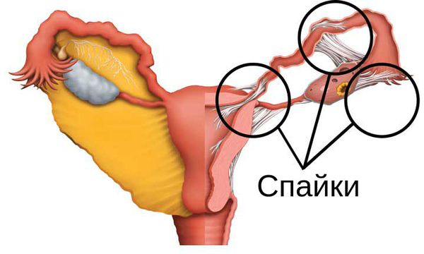 Спайки