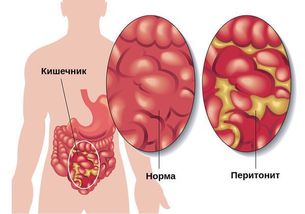 Перитонит