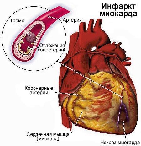 Инфаркт миокарда