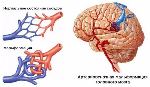 Строение нормальных сосудов и артеровенозной мальформации