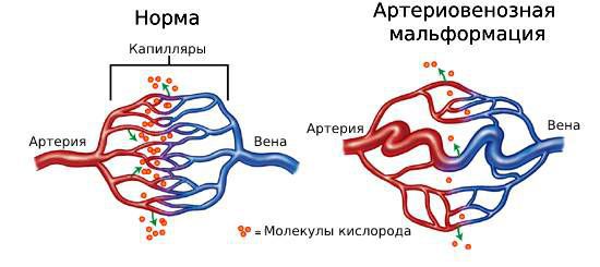 Обмен веществ в норме и при артериовенозной мальформации