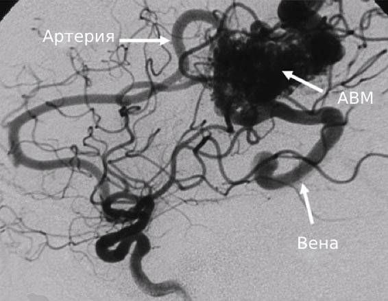 Артериовенозная мальформация. КТ-ангиография.